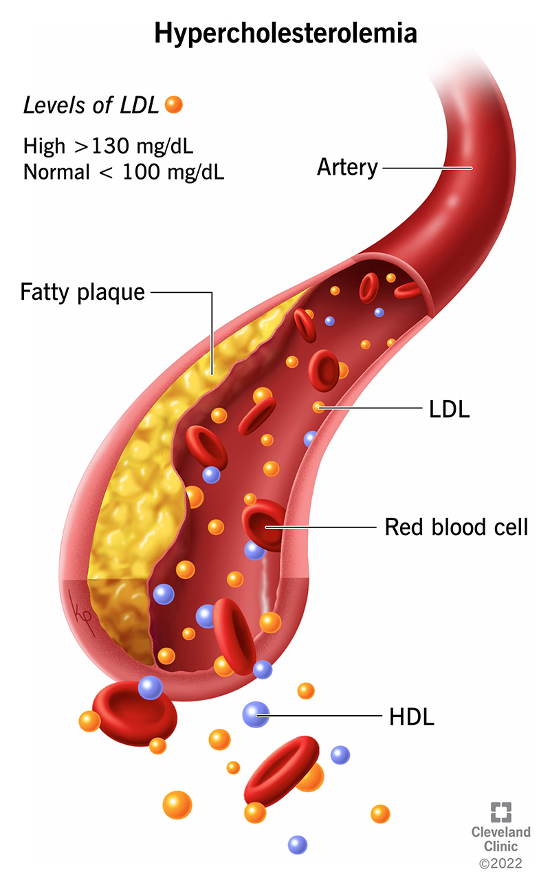 MTL (blogasis cholesterolis) kaupiasi kraujagyslėse ir sudaro riebalines plokšteles.