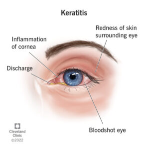 24500 keratitis