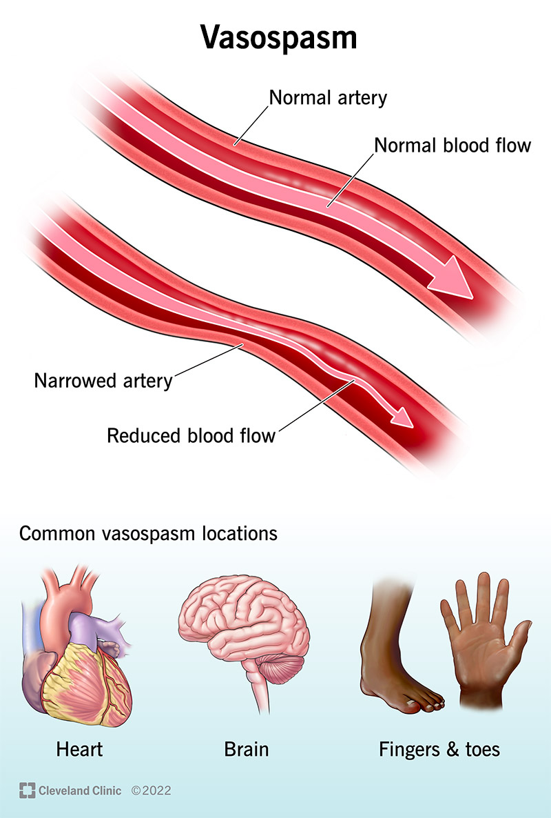 Vazospazmas, dėl kurio sumažėja kraujotaka arterijoje.