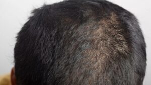 hair loss psoriasis 1455213600