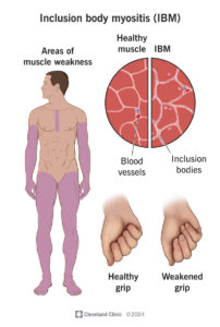 inclusion body myositis