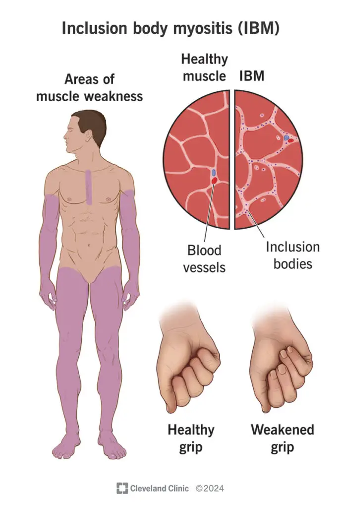 inclusion body myositis