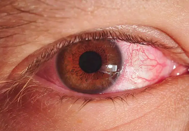 pinkEye 165755073 770x533 1 jpg