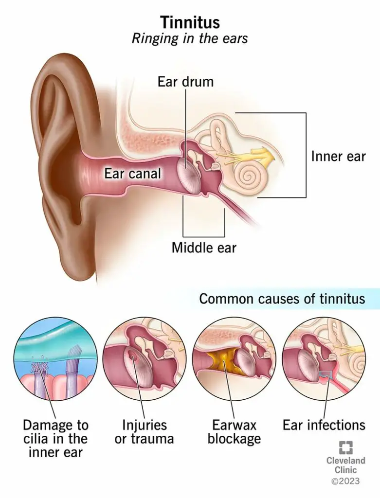 tinnitus