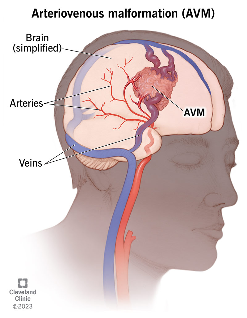 Arterioveninė malformacija atrodo kaip kelios kraujagyslės, susipynusios kartu.