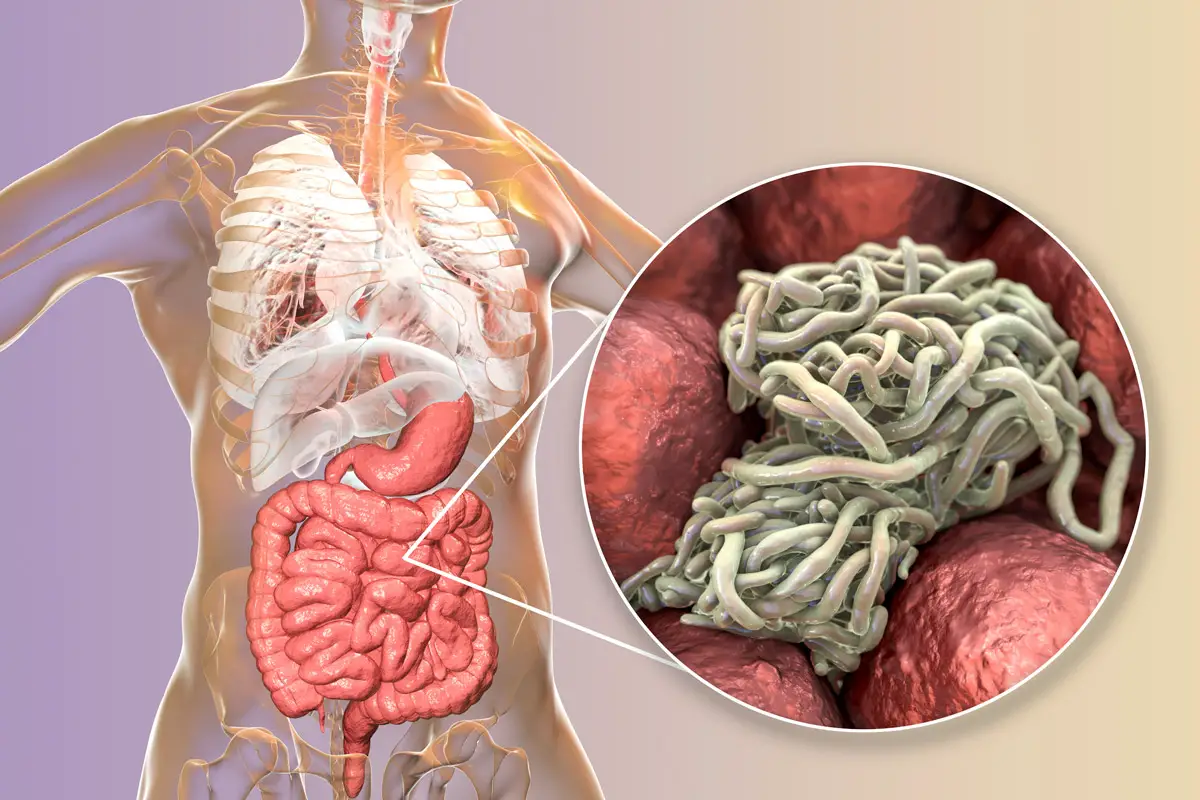 Pinworm lervos susitelkusios plonosios žarnos viduje