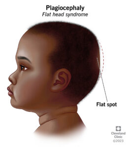 10691 plagiocephaly