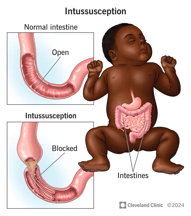 10793 intussusception