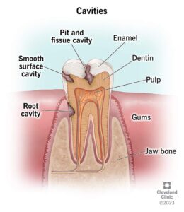 10946 cavities