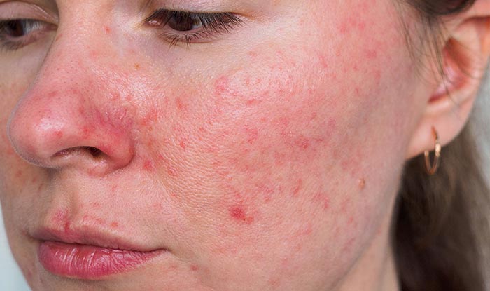 12174 rosacea