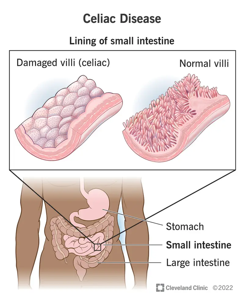 14240 celiac disease