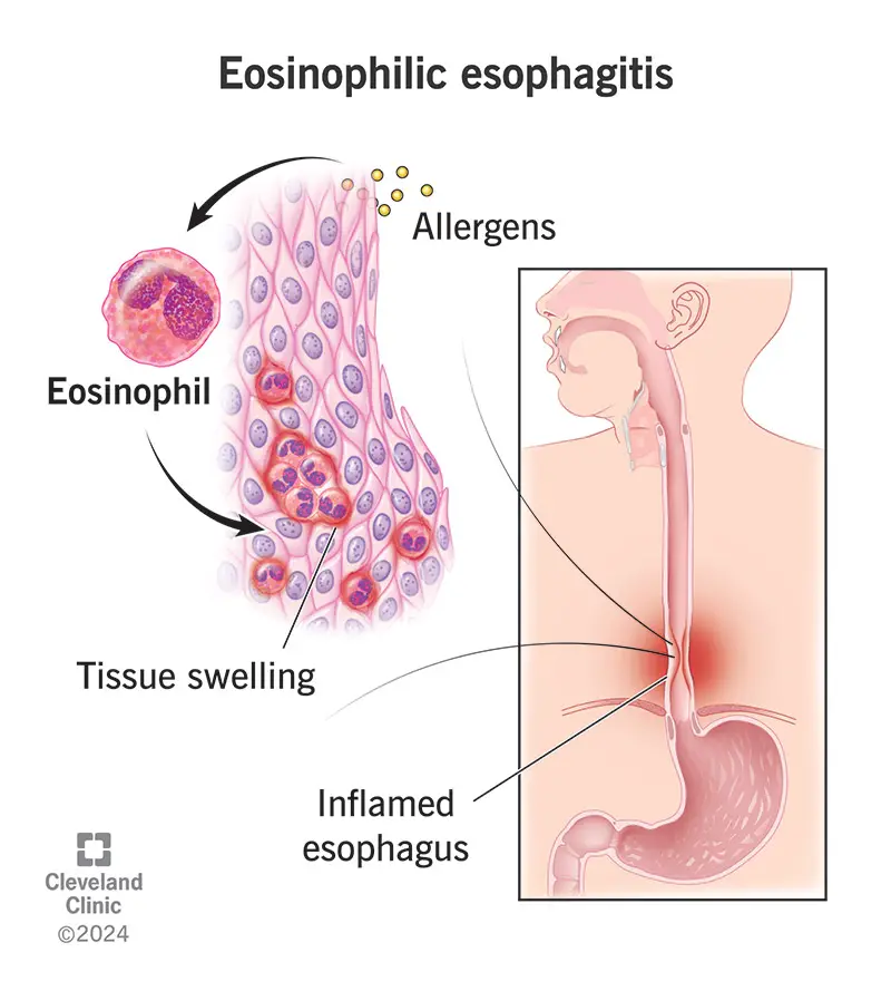 14321 eosinophilic esophagitis