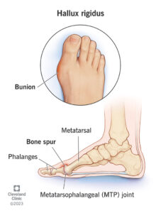 14665 hallux rigidus