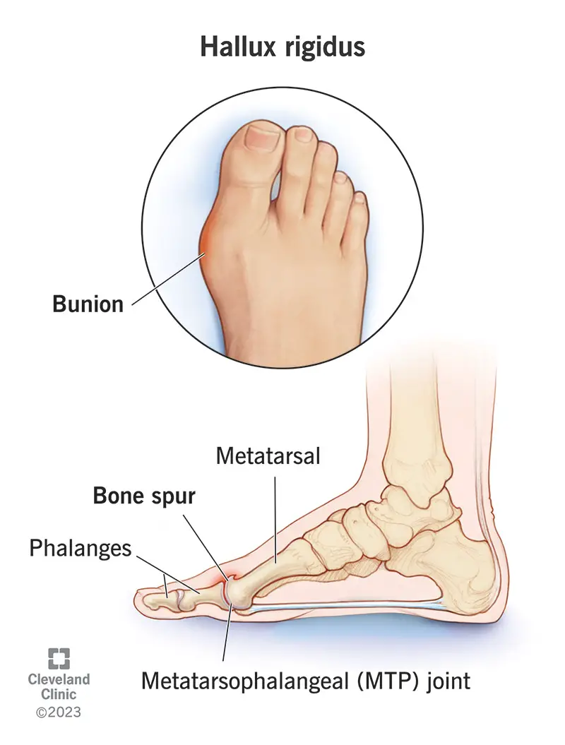 Žmogaus pėdos snukio (hallux rigidus) iliustracija