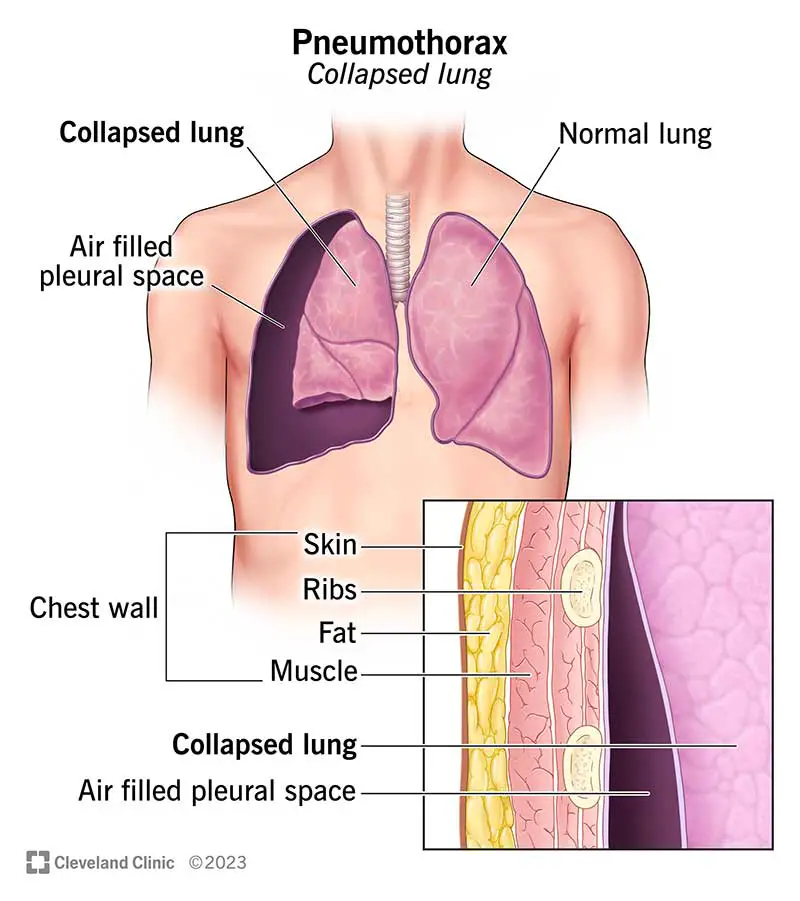 15304 pneumothorax illustration