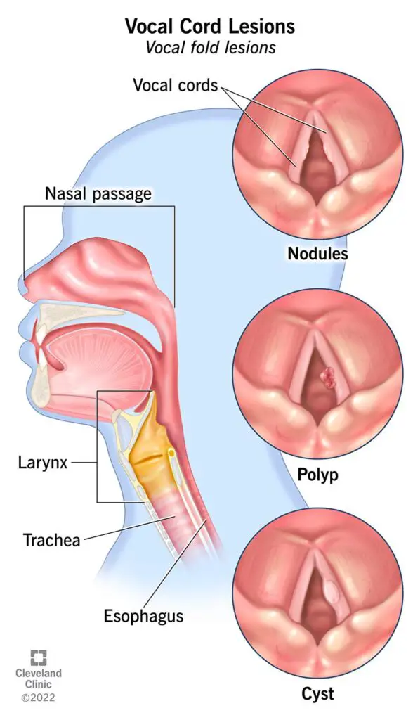 15424 vocal cord lesions