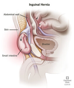 16266 inguinal hernia