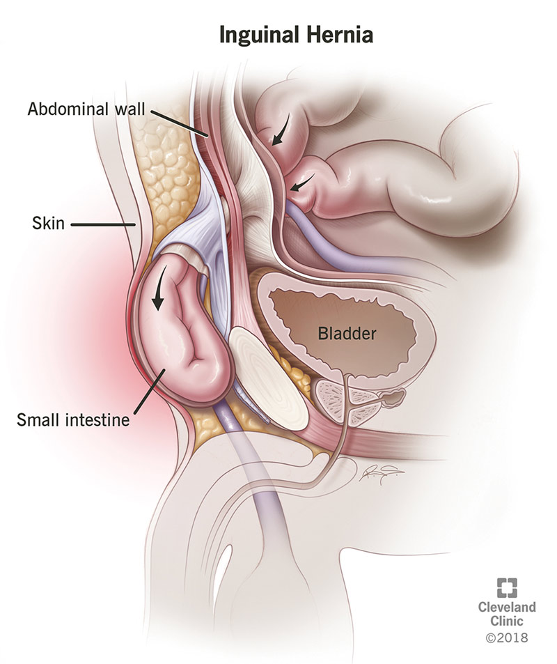 16266 inguinal hernia