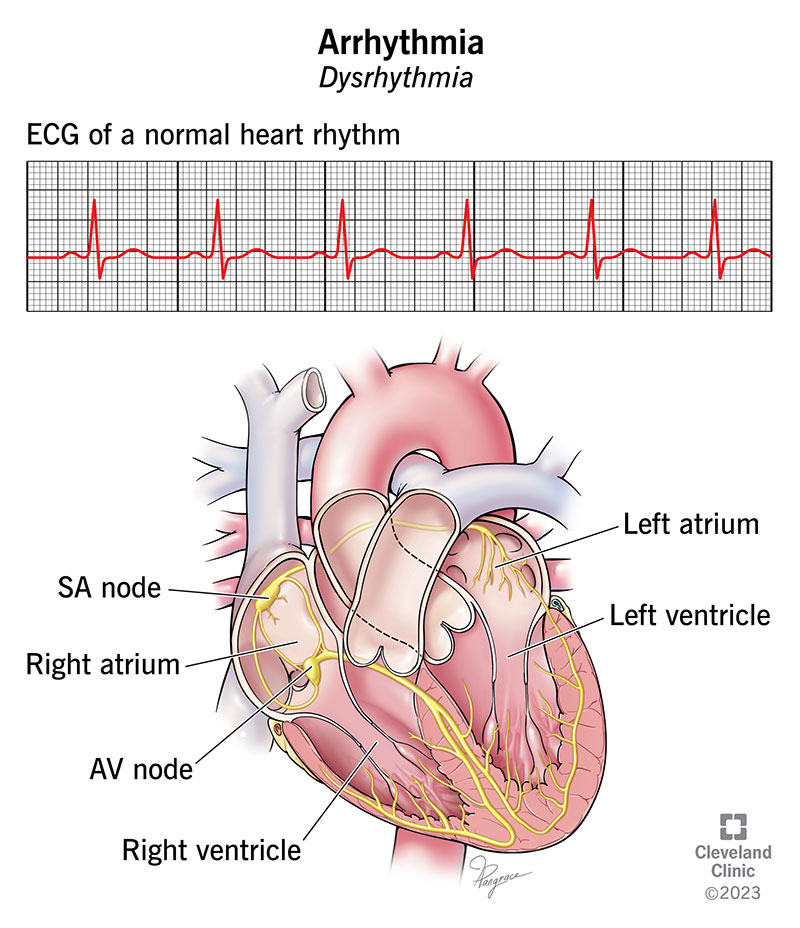 16749 arrhythmia illustration