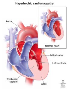 17116 hypertrophic cardiomyopathy