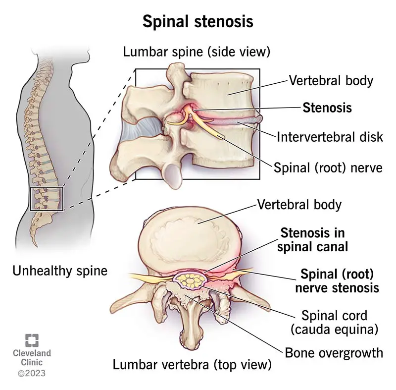 17499 spinal stenosis 02