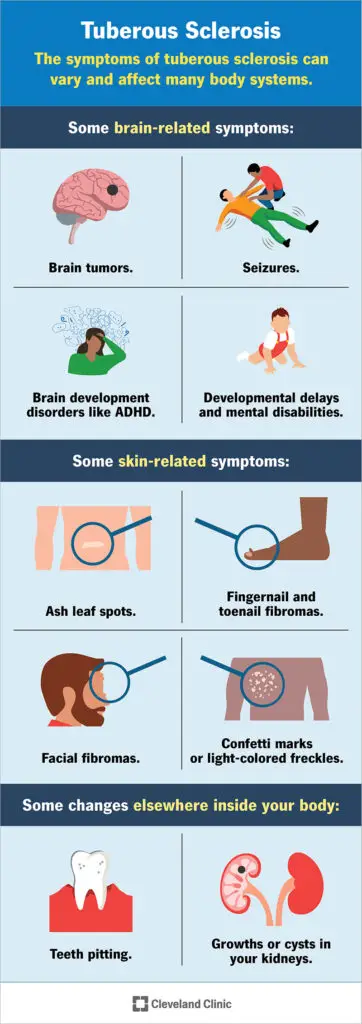 17586 tuberous sclerosis