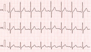 17616 normal ekg