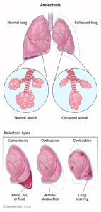 17699 atelectasis