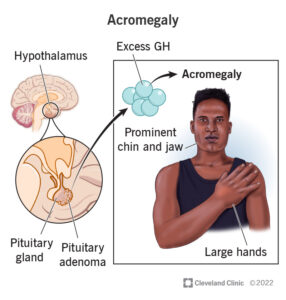 17743 acromegaly