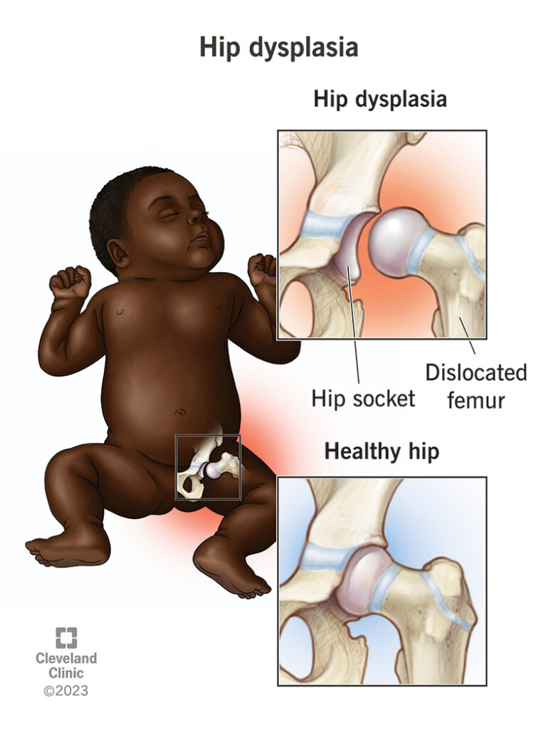 17903 hip dysplasia 2