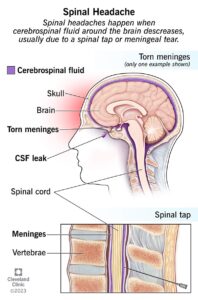 17927 spinal headaches 1