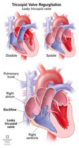 21627 tricusp valve regurgitation illustration