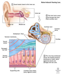 21776 noise induced hearing loss