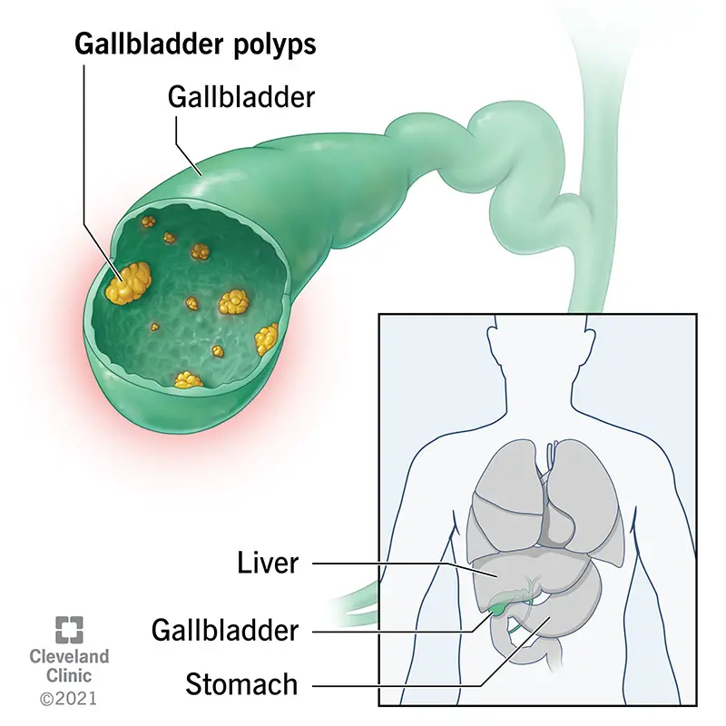 21821 gallbladder