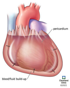 21906 cardiac tamponade illustration 01