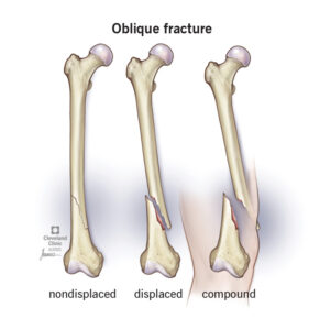 22185 oblique fracture