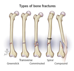 22241 spiral fractures