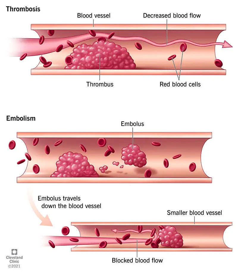 22242 thrombosis illustration