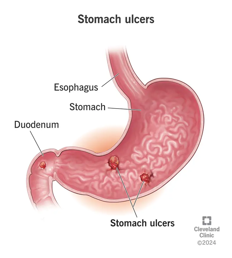 22314 stomach ulcer