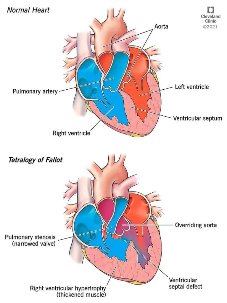 22343 tetralogy of fallot