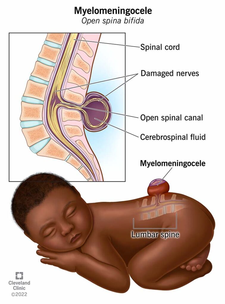 22813 myelomeningocele