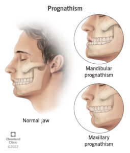 22872 Prognathism