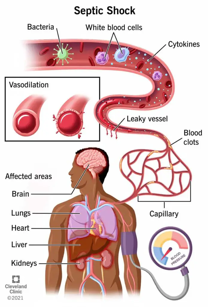 23255 septic shock