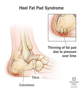 23275 heel fat pad syndrome