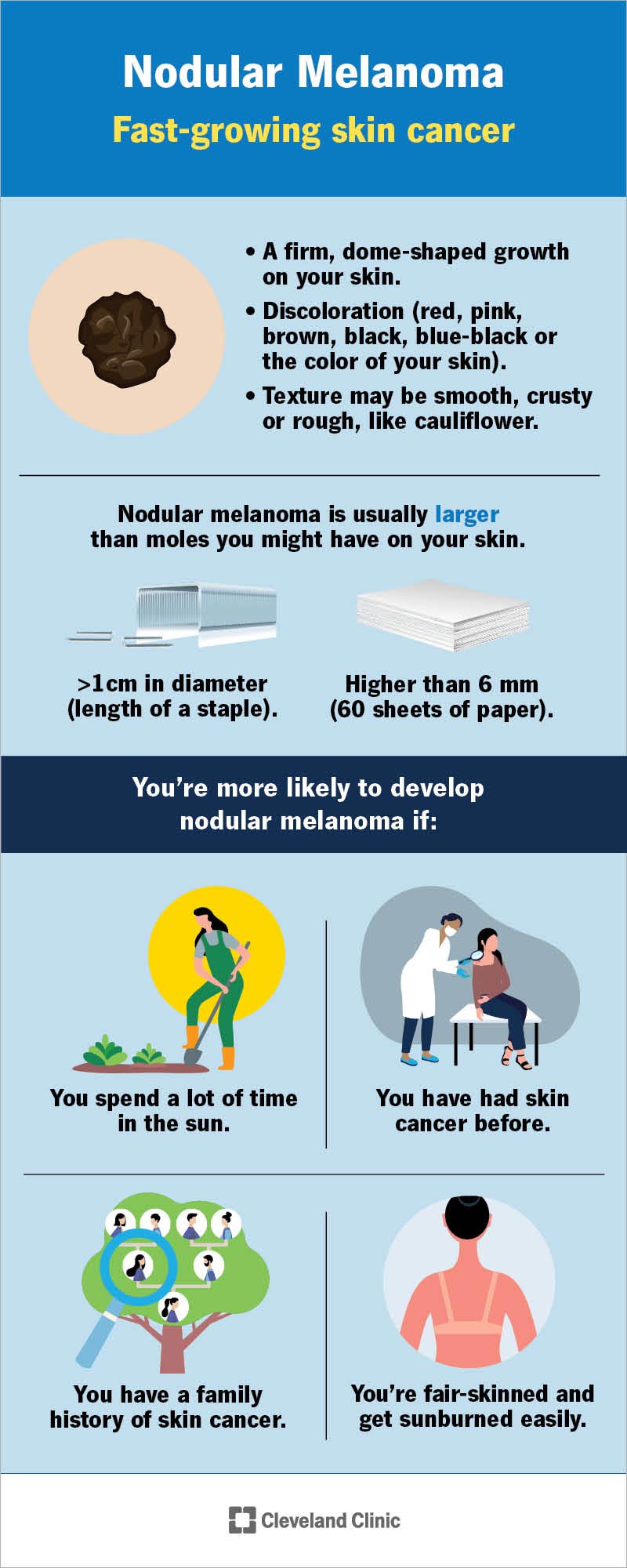 Diagrama, apibūdinanti mazginės melanomos ypatybes ir tuos, kuriems yra didžiausia tikimybė susirgti mazgine melanoma.