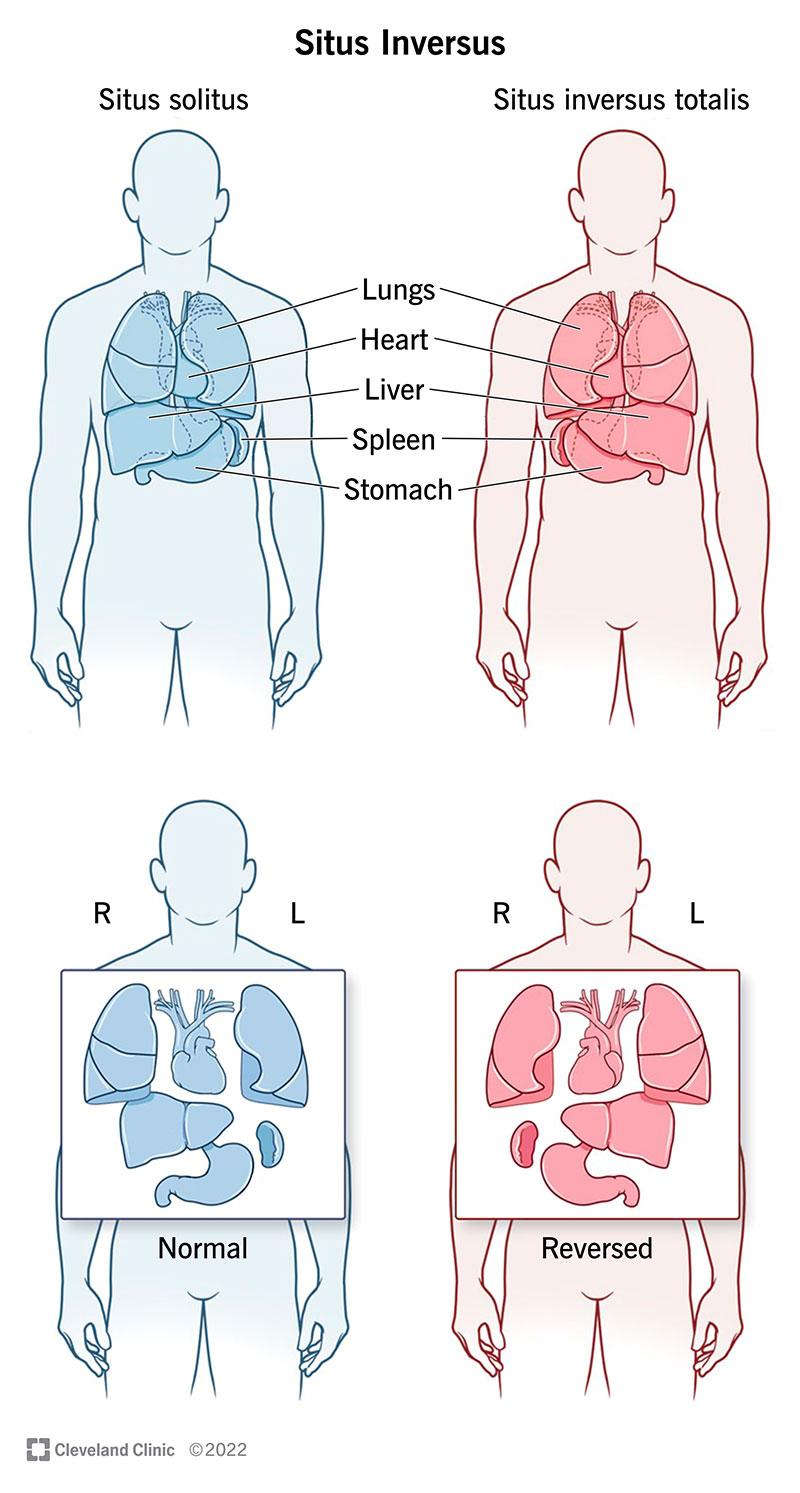 23486 situs inversus