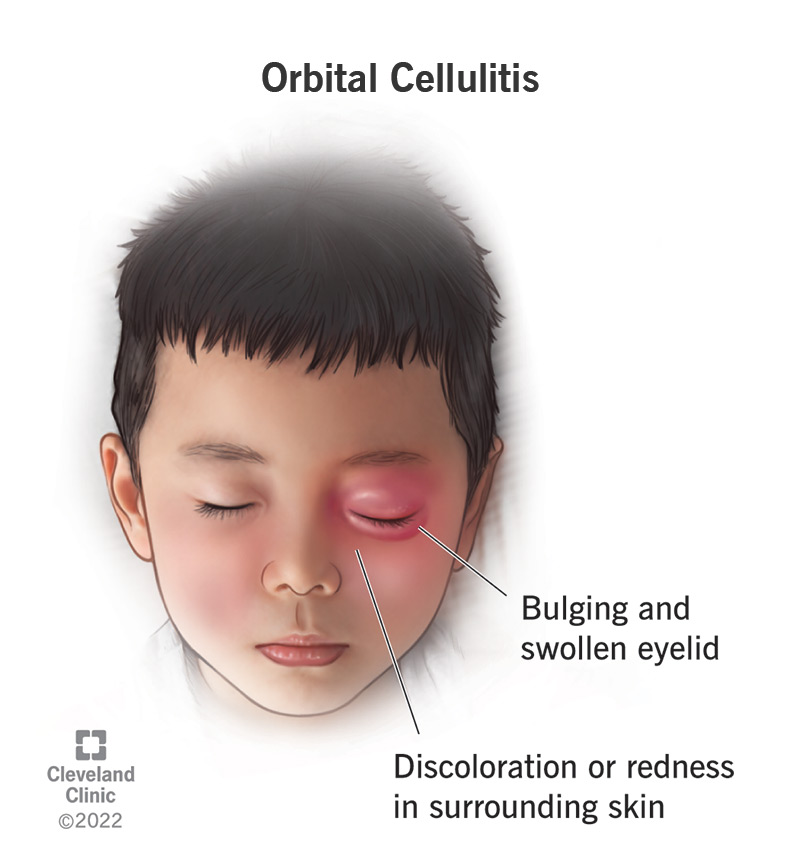 Orbitinis Celiulitas: Simptomai Ir Gydymas - SFOMC