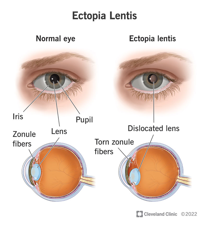 24551 ectopia lentis