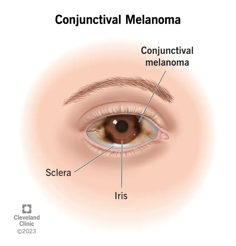 24895 conjunctival melanoma