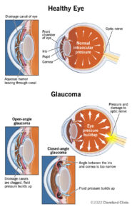 4212 glaucoma